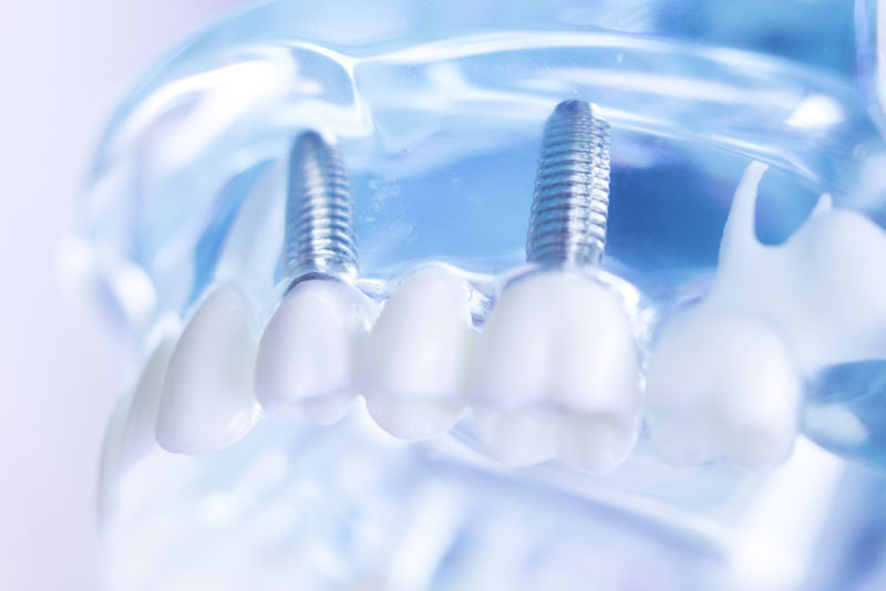 A dental model displaying prosthetic teeth, gums, and titanium screw implants, used for teaching and demonstrating dental implant procedures.