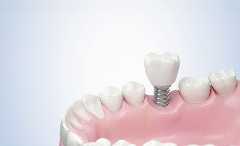 Complete Teeth Replacement: The Perks of Dental Implants Explained